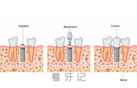 种植牙怎么“种”进嘴巴里的？