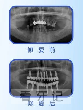 杭州口腔医院湖州分院院长胡其勇种牙记