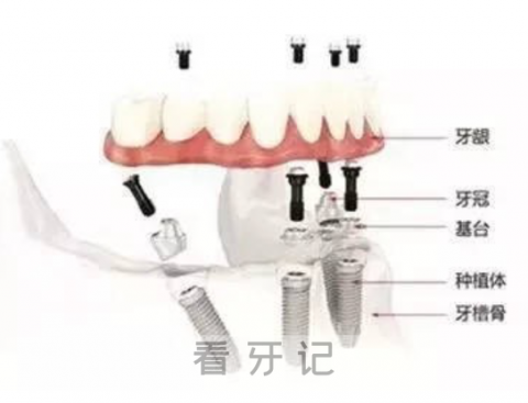 全口种植术前及术后注意事项