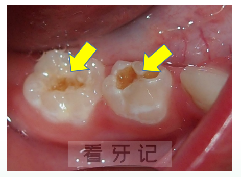 孩子乳牙有问题不必管等换牙就好了