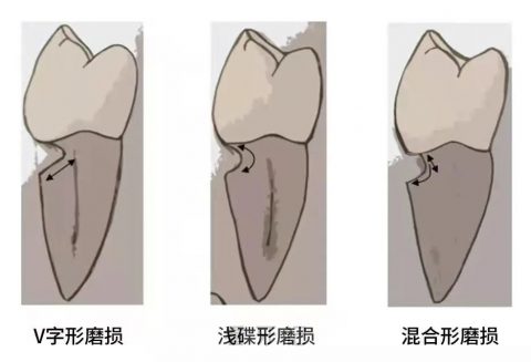 楔状缺损图片科普预防