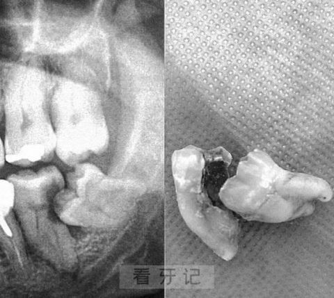 拔智齿要3000我是不是被坑了