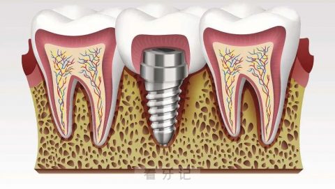 种植牙价格贵吗