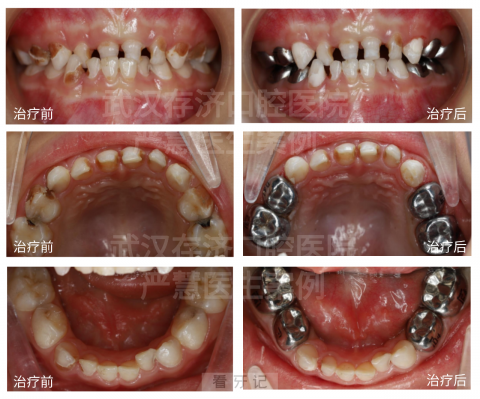 武汉**儿童舒适化诊疗中心看牙记