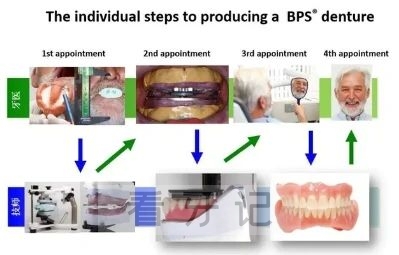 BPS生物功能性义齿系统