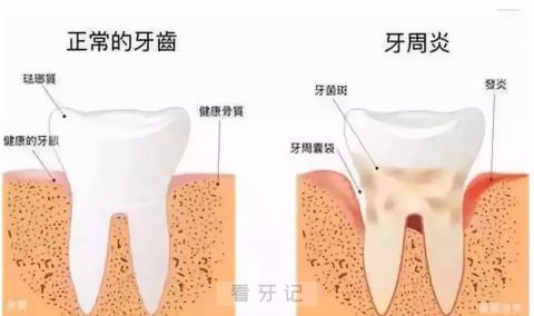 谈恋爱不要找有牙周炎的人