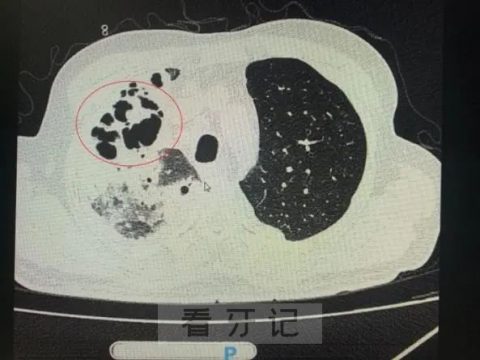 种植牙太危险了种牙差点导致死亡