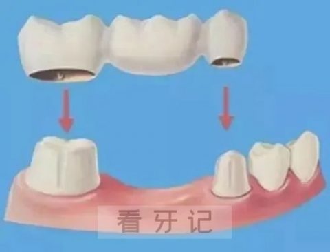 缺牙修复固定桥好不好