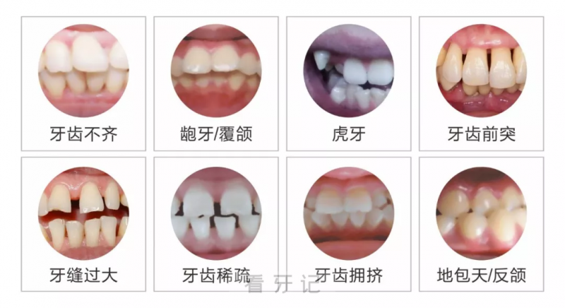 八种常见牙齿不齐需要矫正牙齿图片