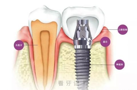 种植牙一期二期三期分类科普