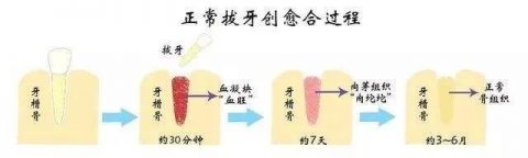 拔牙后接吻危害之一感染干槽症