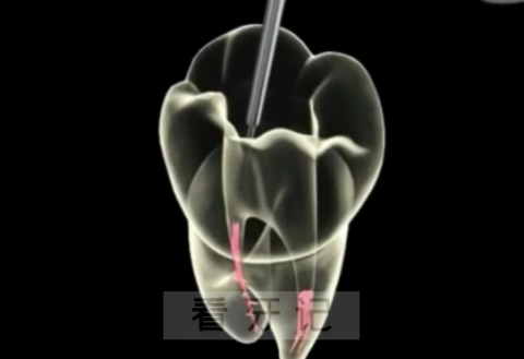 根管治疗后三大危害要避免