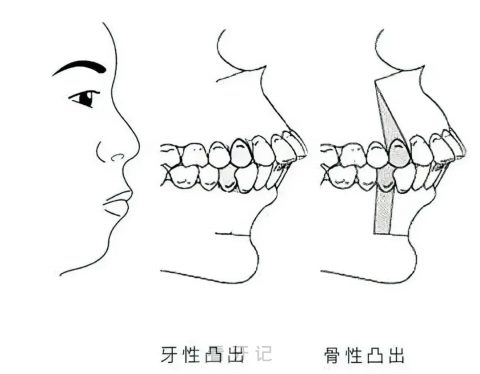 牙性龅牙骨性龅牙区别四大攻略