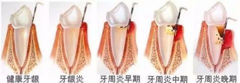 牙龈萎缩真实实拍图片