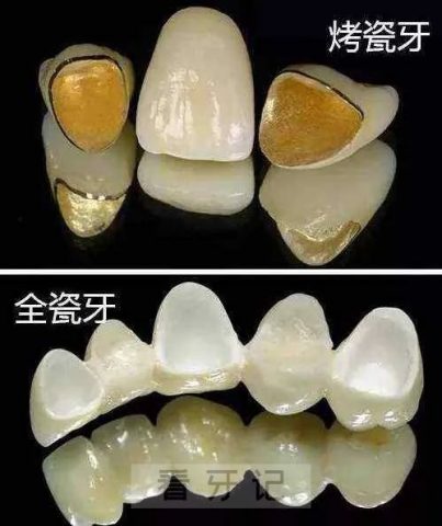 全瓷牙这么贵是不是智商税附五大优点