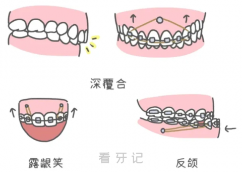 哪些正畸人群需要打骨钉