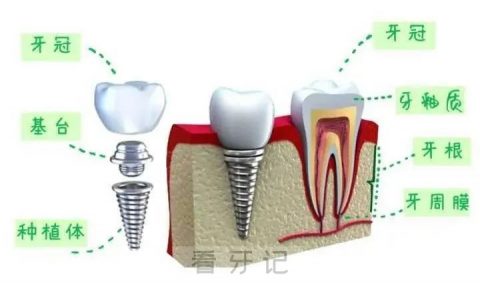 种植牙六大优点最新版