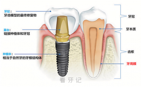 种植牙三大组成部分