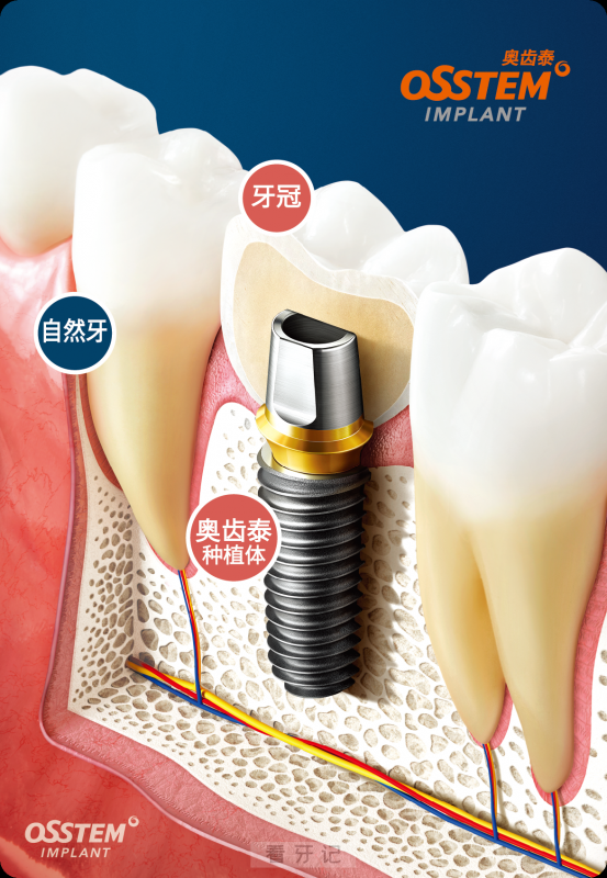 韩国奥齿泰种植牙高清图片