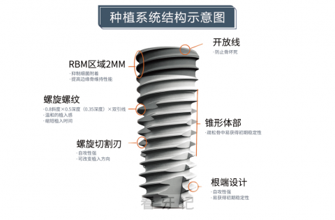 奥齿泰种植牙四大优势