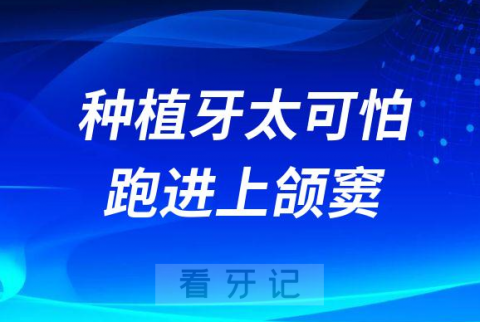 种植牙太可怕太吓人了竟然“跑”进上颌窦可能会引起颅内感染