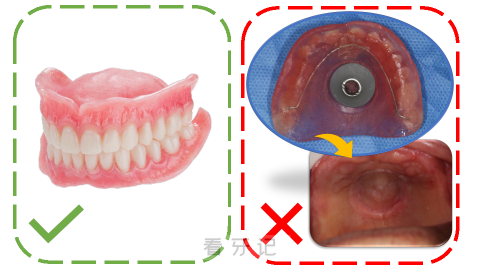 什么是吸附性义齿附真实图片