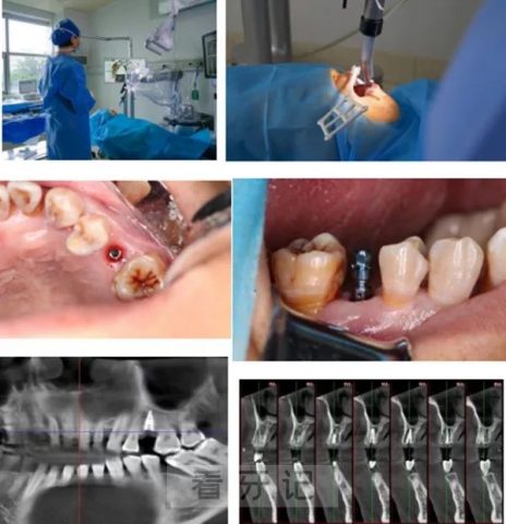 **口腔种植科完成一例种植牙机器人种植手术