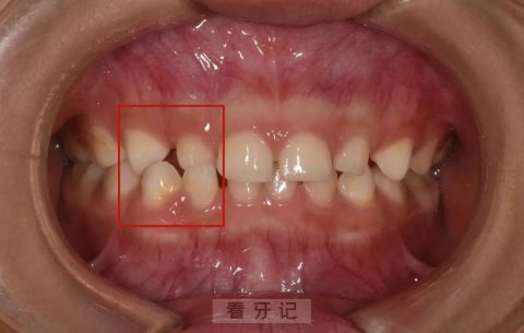 乳牙反颌地包天真实图片