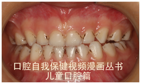 孩子牙变黑是不是蛀牙虫牙