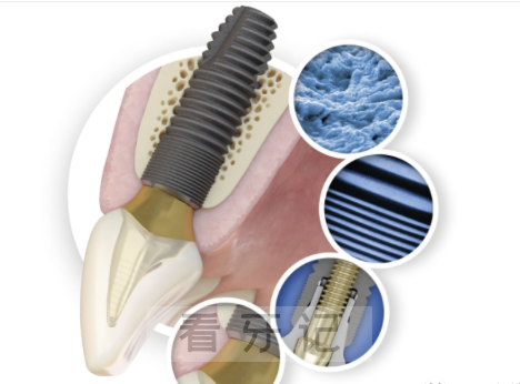 世界三大种植牙瑞典Astra种植牙介绍及四大特点