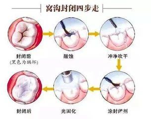 长沙**医院|窝沟封闭最新科普知识大全