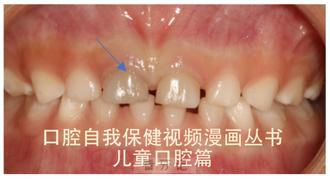 孩子牙变黑是不是蛀牙虫牙