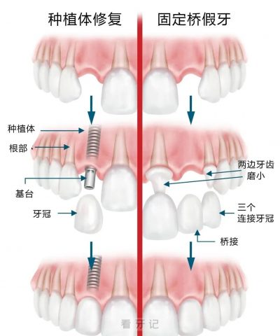 种植牙烤瓷桥活动假牙哪个最好最适合自己