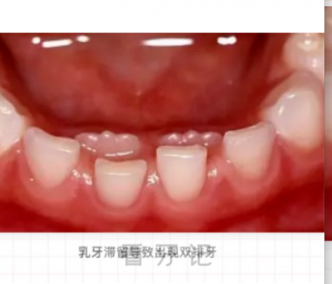 孩子长了“双排牙”医生说不能拔是真的假的