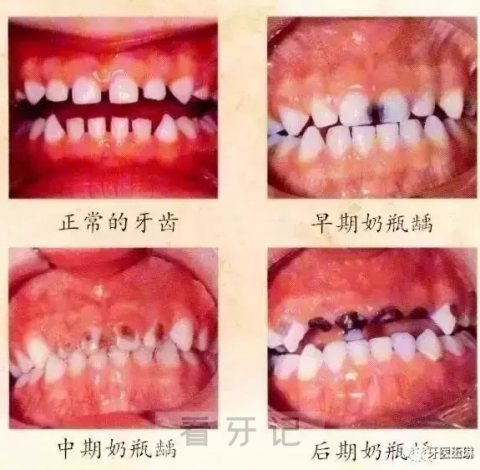 奶瓶龋各阶段图片