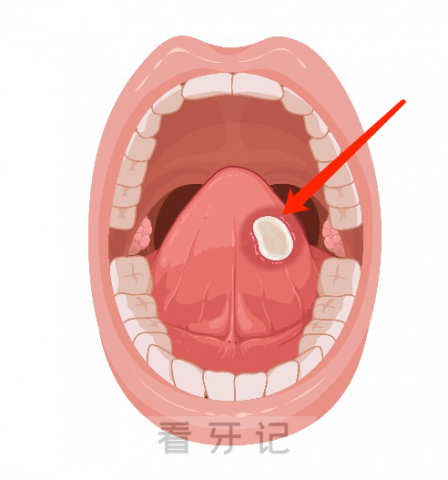 早期舌癌症状附图片