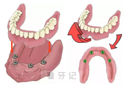种植覆盖义齿和全口种植牙有什么区别