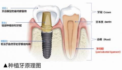 种植牙的前世今生