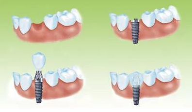 种植牙五大流程