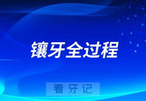 镶牙全过程六大步骤