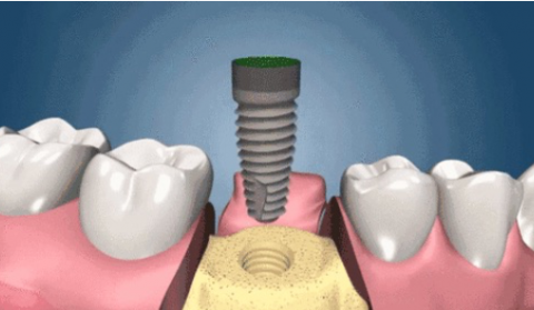 种植牙真实流程图片解说最新完整版