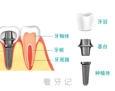 种植牙真实流程图片解说最新完整版