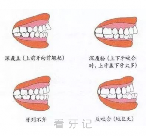 太可怕了牙齿畸形一定要尽早治疗