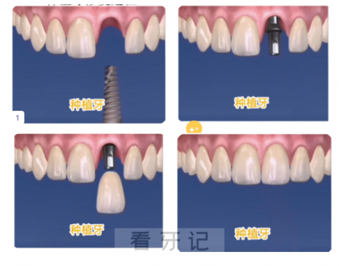种植牙的全部过程附图片