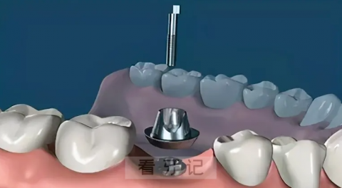 种植牙真实流程图片解说最新完整版