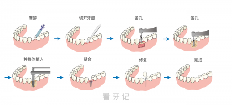 种植牙完整流程图最新版