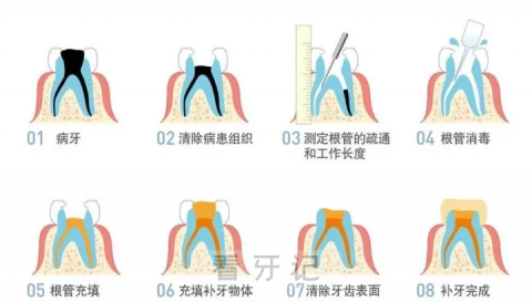 为什么不直接补牙要做根管治疗是不是骗局