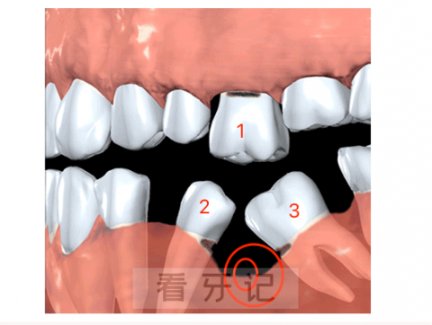 缺一颗牙会影响3颗牙是真的假的