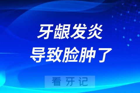 甲流牙龈发炎导致脸肿了怎么办一般几天能好