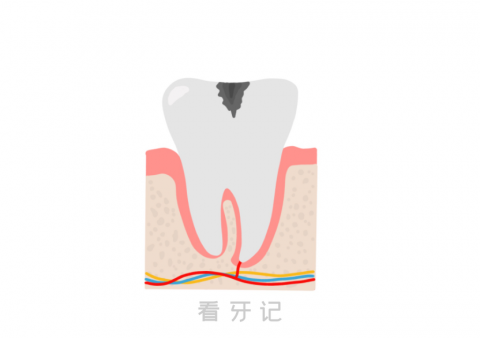 让人瑟瑟发抖的龋齿到底是怎么形成的